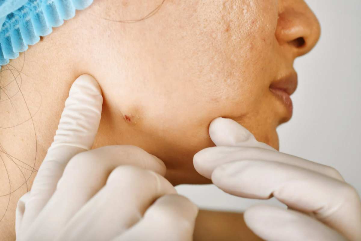 donna con acne